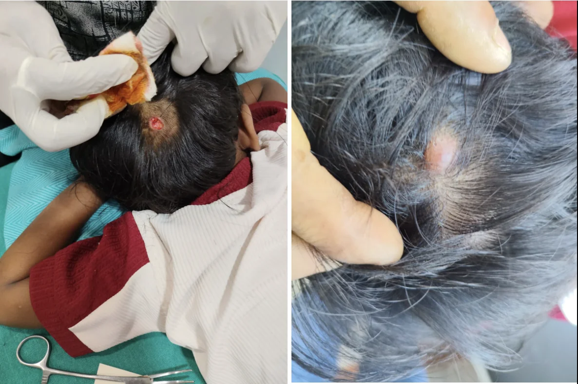 Dr Rohit Gupta, the best dermatologist in Nepal performing a cyst surgery