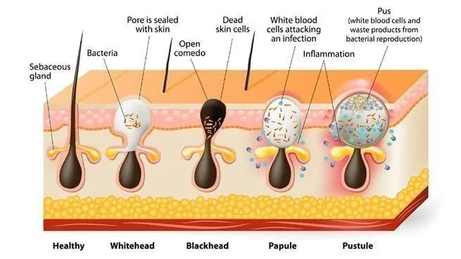 Dr Rohit Gupta explains How Acne Forms