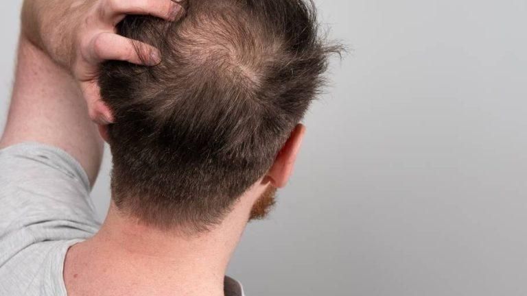 Hair Loss Treatment - Dermatology treatment by Dr. Rohit Gupta in Birgunj