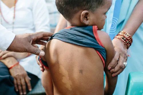 Leprosy Treatment (Hansen’s Disease) - Dermatology treatment by Dr. Rohit Gupta in Birgunj