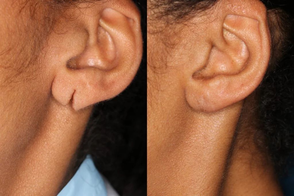 Split Earlobe Repair (Lobuloplasty) - Dermatology treatment by Dr. Rohit Gupta in Birgunj