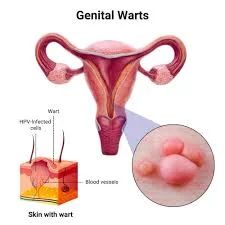 Genital Warts (HPV) Removal & Therapy - Dermatology treatment by Dr. Rohit Gupta in Birgunj
