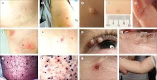 Molluscum Contagiosum Extraction - Dermatology treatment by Dr. Rohit Gupta in Birgunj