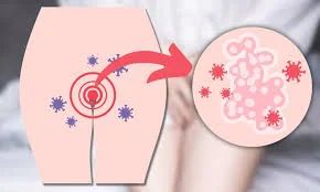 Genital Dermatoses & Itch (Non-Venereal) - Dermatology treatment by Dr. Rohit Gupta in Birgunj