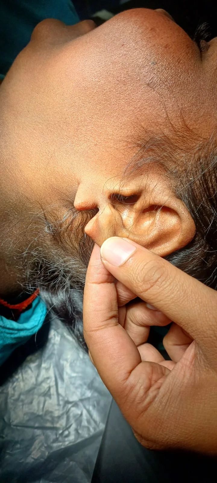 Split Earlobe Repair: Restoring Aesthetics Through Lobuloplasty - Dr. Rohit Gupta Dermatologist Blog