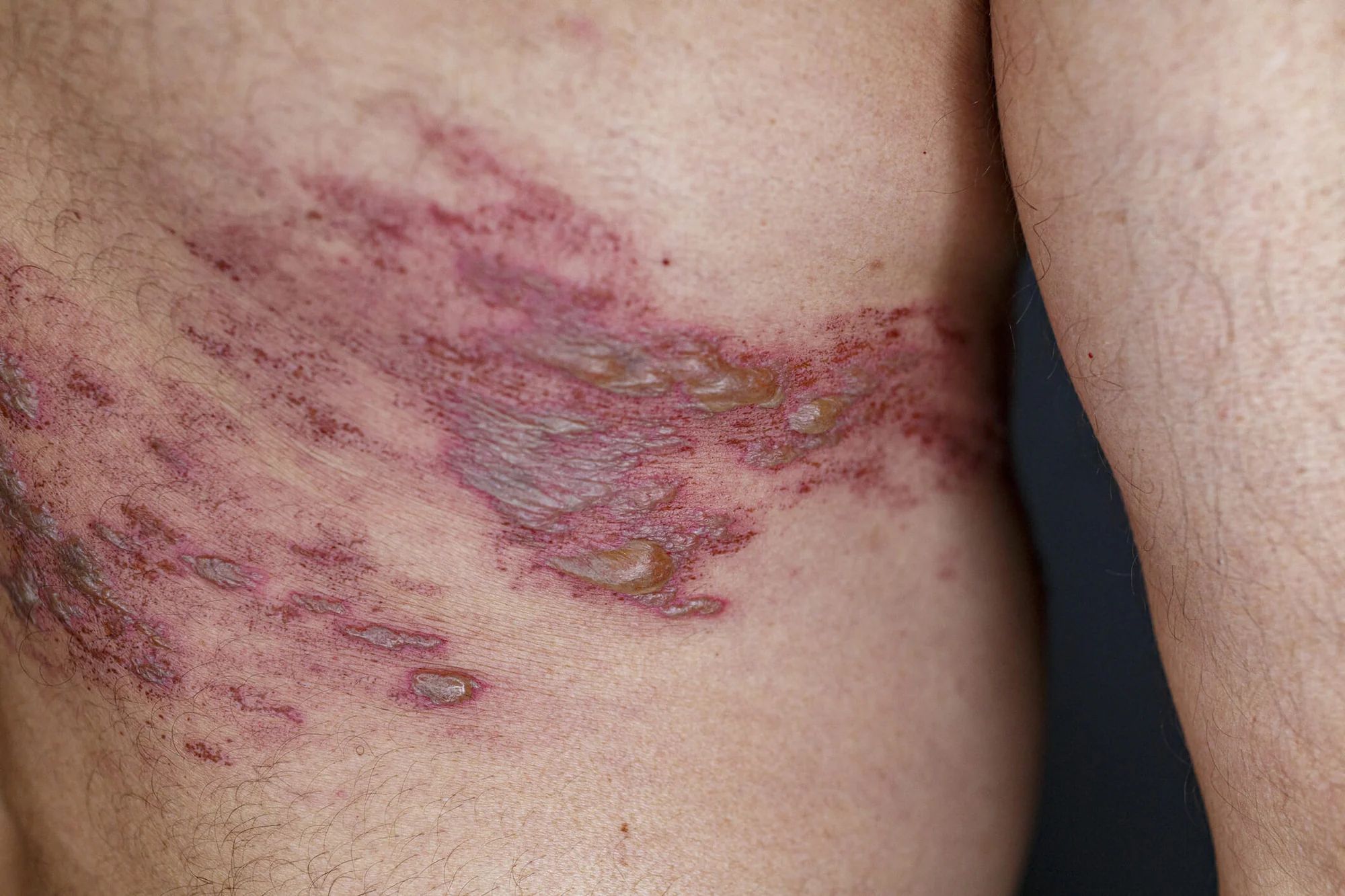 जनै खटिरा (Herpes Zoster) के हो? जान्नुहोस् यसका लक्षण, कारण र उपचार - Dr. Rohit Gupta Dermatologist Blog