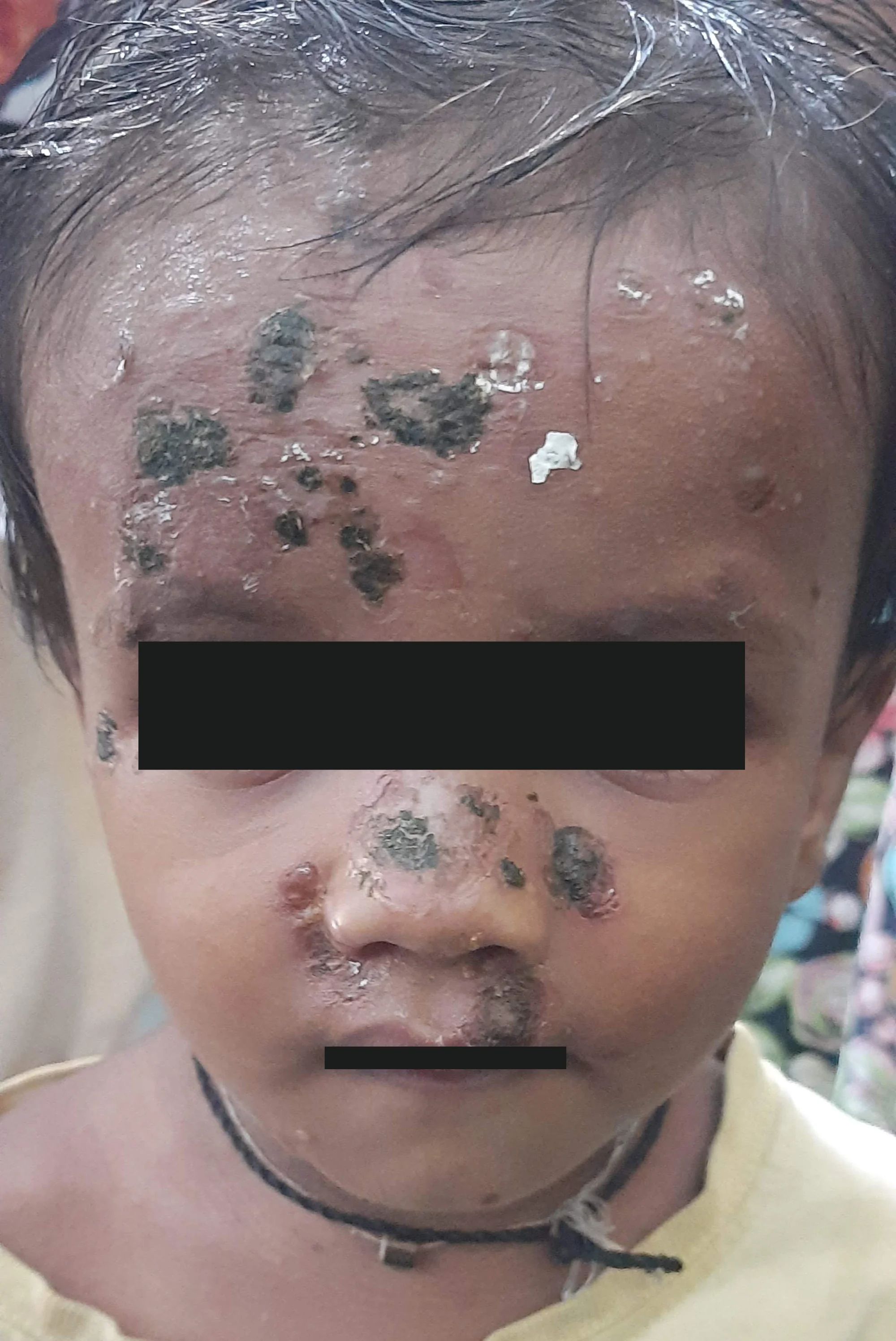 इम्पेटिगो कन्टाजियोसा (Impetigo Contagiosa): छिट्टै सर्ने छालाको संक्रमण - Dr. Rohit Gupta Dermatologist Blog